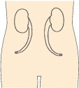 尿管皮膚瘻ストーマ（両側）